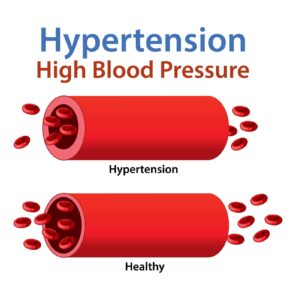 high blood pressure